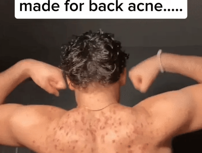 <h2>Clear Back Acne In Weeks</h2>